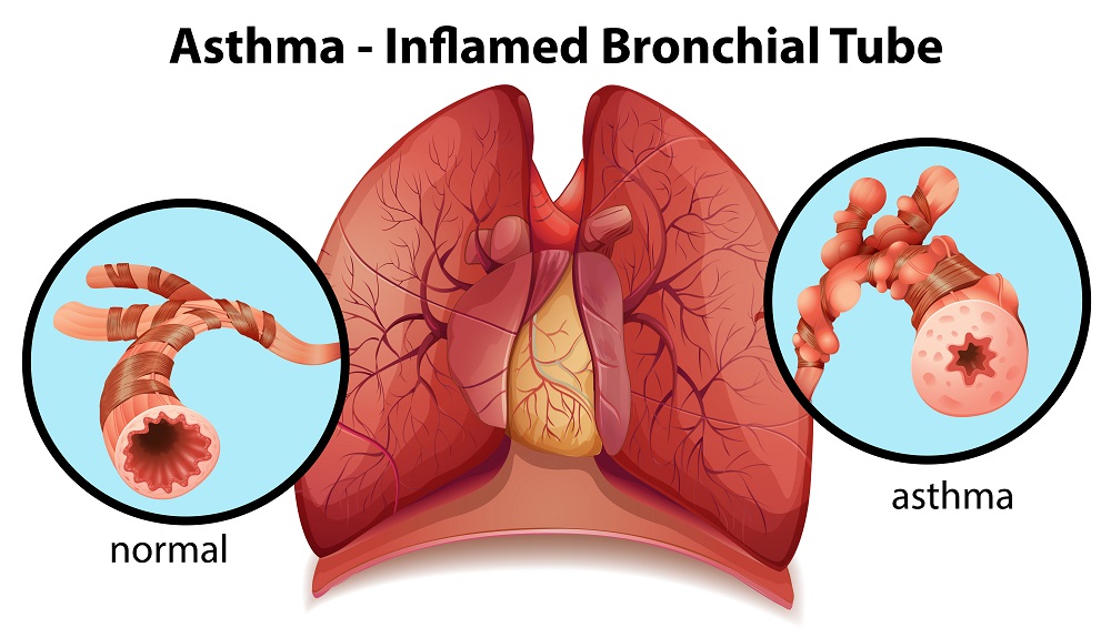 Content Brief for Breathe Easy: It’s Asthma Awareness Month